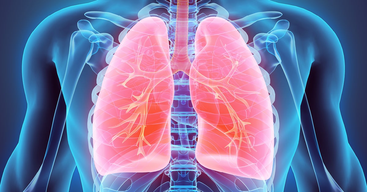 Finding lung cancer early through screening can be the key to a successful outcome.