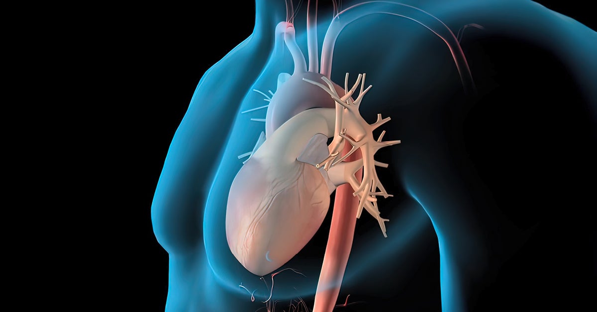 Aortic Aneurysm