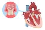 An illustration of a Transcatheter Aortic Valve Replacement (TAVR)