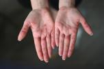 Hand, foot and mouth disease is common in children, but adults also get it. Learn what we can all do to prevent and treat HFMD.