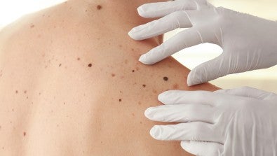 Melanoma screening