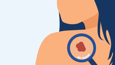 Skin cancer screening 