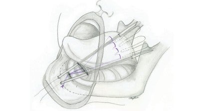 Mann Tongue Lip Adhesion