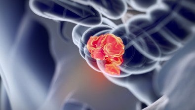 Lehigh Valley Topper Cancer Institute first site in Pennsylvania to Participate in Pioneering Rectal Cancer Trial