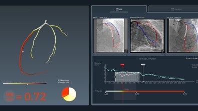 Lehigh Valley Heart and Vascular Institute among the few nationwide evaluating new technology in determining treatment options