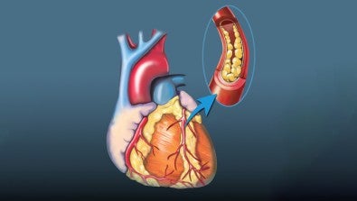 Cardiac Catheterization