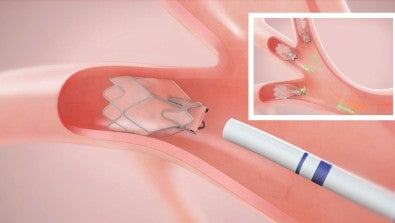 Zephyr Valves Opening Up Treatment Options for People With COPD