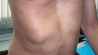 Pediatric Chest Wall Surgery