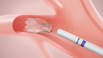 Bronchoscopic lung volume reduction - BLVR