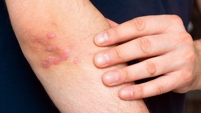 Psoriasis