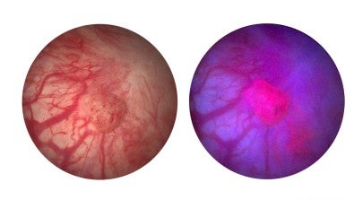 LVHN blue light cystoscopy