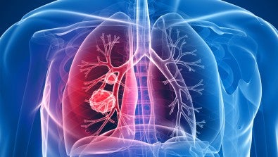 LVHN’s Lung Nodule Clinic and Ion robotic bronchoscopy 