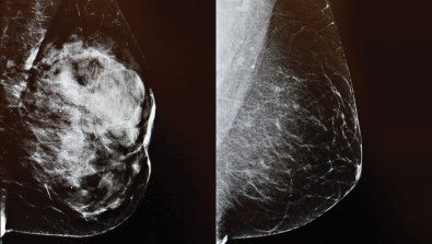 3D imaging Mammogram at LVHN