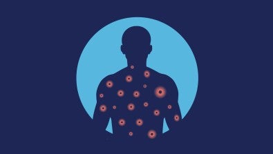 What you need to know about measles