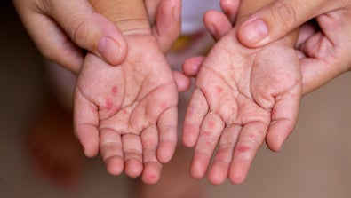 Learn how HFM spreads, symptoms and treatment tips from NP Travis Green. Protect kids and parents, manage day care rules and prevent complications.