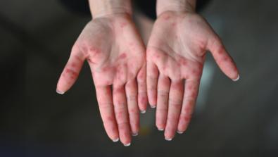 Hand, foot and mouth disease is common in children, but adults also get it. Learn what we can all do to prevent and treat HFMD.