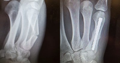 Lehigh Valley Orthopedic Institute Hand Surgeon Saves the Season for Souderton High Lacrosse Player