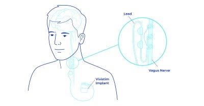 Stroke Patients Increase Upper Limb Function Using Breakthrough Treatment 