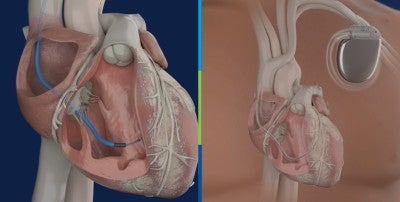 the Lead Evaluation for Defibrillation and Reliability (LEADR) clinical trial
