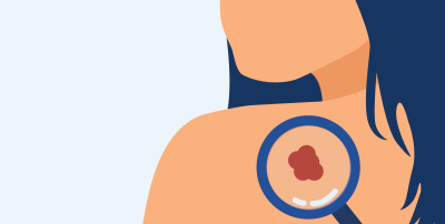 Skin cancer screening 