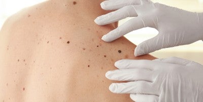 Attendees will learn about the latest advances in melanoma care while celebrating survivorship.