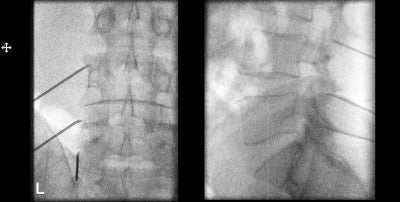 Degenerative Joint Pain 