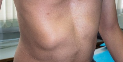 Pediatric Chest Wall Surgery