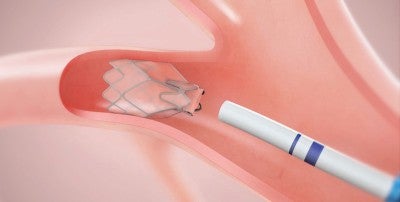 Bronchoscopic lung volume reduction - BLVR