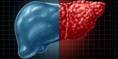 Cut Your Risk for Fatty Liver Disease