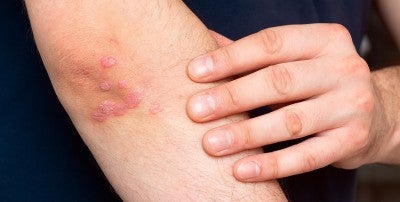 Psoriasis