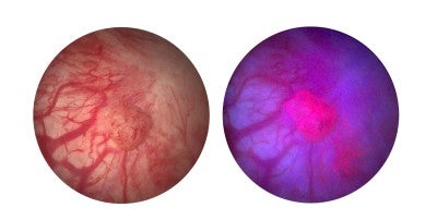 LVHN blue light cystoscopy