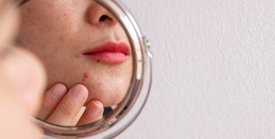 Acne: Not Just for Teens
