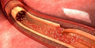 SCAD: The Under-the-Radar Heart Problem