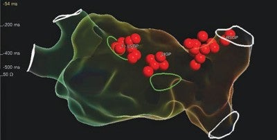 New Treatment for Vasovagal Syncope 