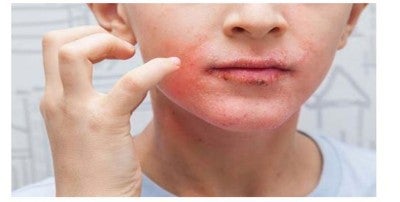 Pediatric dermatology