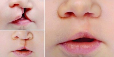 Cleft Lip and Palate