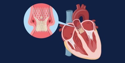 Lehigh Valley Heart and Vascular Institute recently surpassed 2,000 TAVR procedures, with the program continuing to shine for its great outcomes.