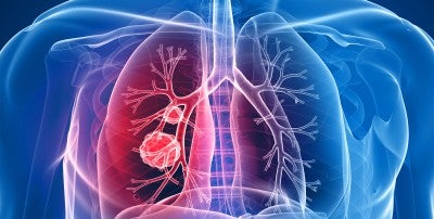 LVHN’s Lung Nodule Clinic and Ion robotic bronchoscopy 