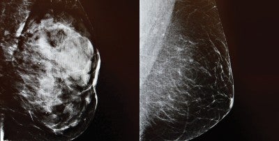 3D imaging Mammogram at LVHN