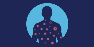 What you need to know about measles