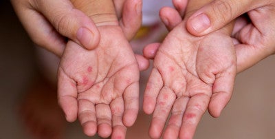 Learn how HFM spreads, symptoms and treatment tips from NP Travis Green. Protect kids and parents, manage day care rules and prevent complications.