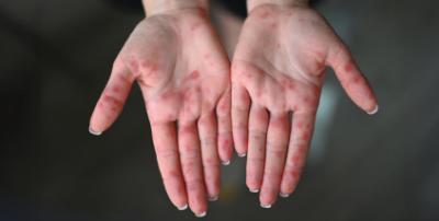 Hand, foot and mouth disease is common in children, but adults also get it. Learn what we can all do to prevent and treat HFMD.