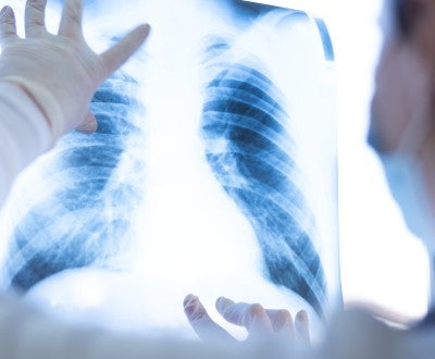 Lung Cancer Screening