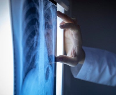 Lung Cancer Screening and Diagnosis