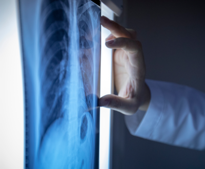 Lung Cancer Treatment