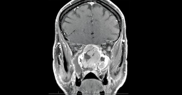 Brain