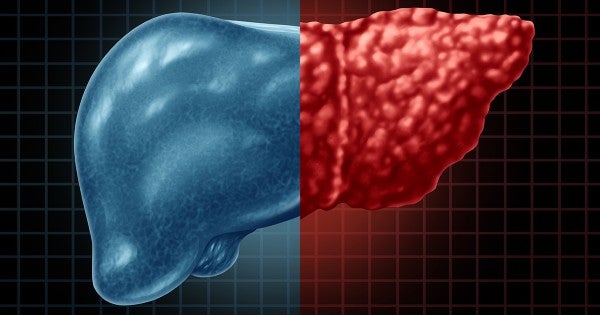Cut Your Risk for Fatty Liver Disease