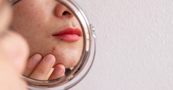 Acne: Not Just for Teens