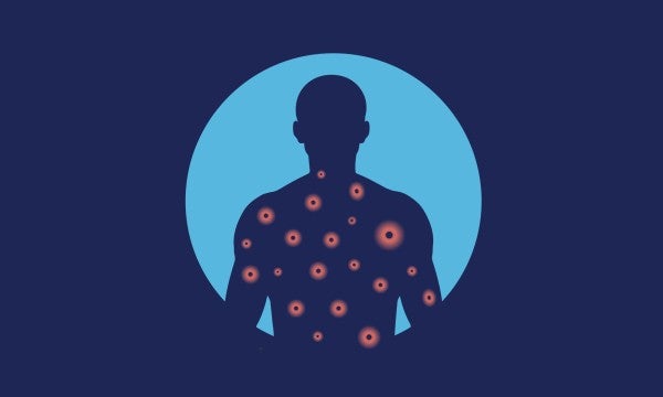 What you need to know about measles