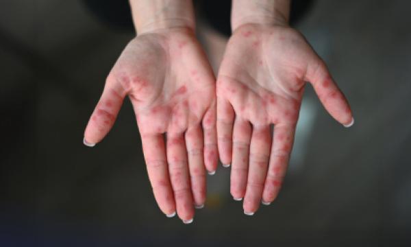 Hand, foot and mouth disease is common in children, but adults also get it. Learn what we can all do to prevent and treat HFMD.